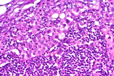 Urothelial carcinoma - lymph node metastasis, very high mag photo