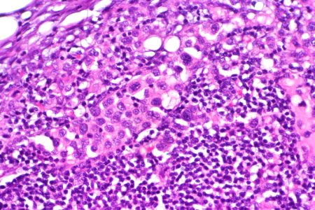 Urothelial carcinoma - lymph node metastasis, very high mag