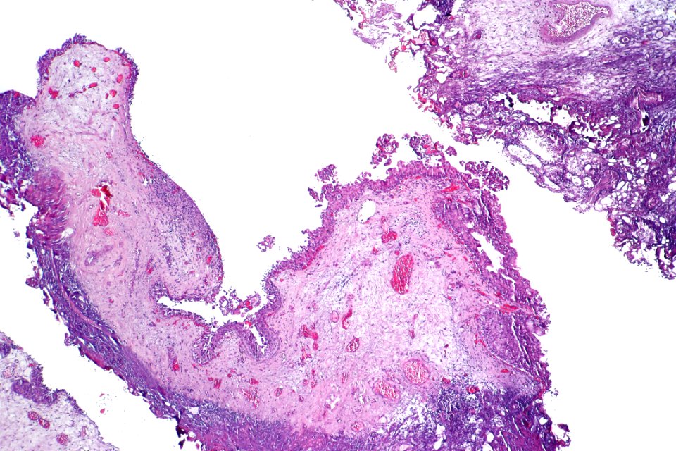 Urothelial carcinoma in situ (micropapillary), low mag