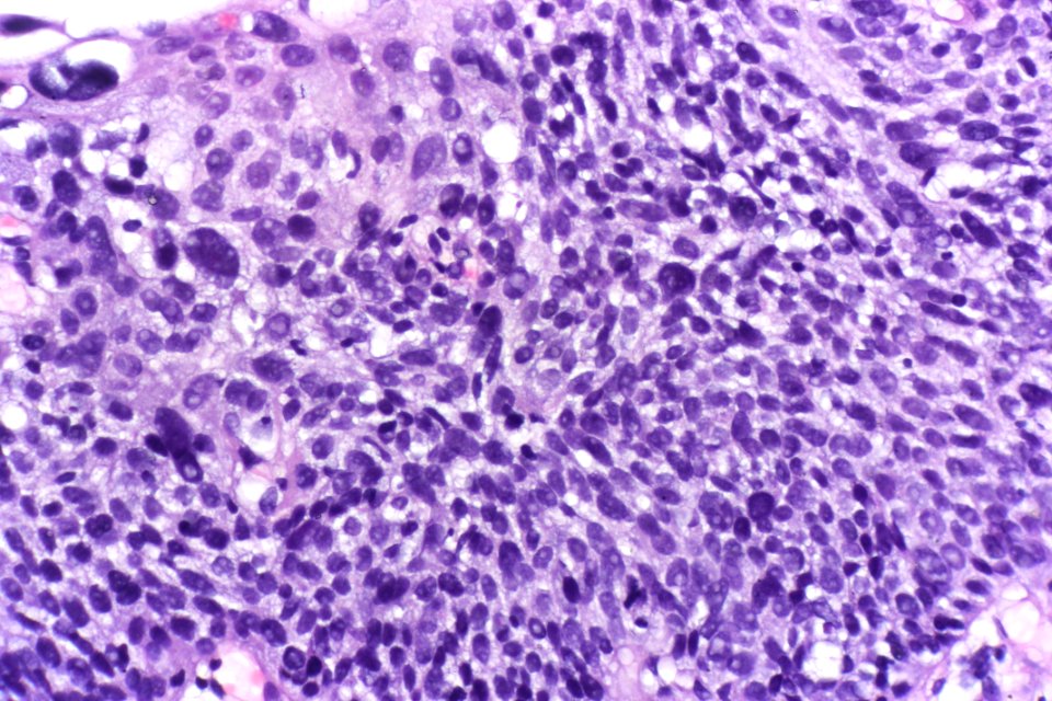 Urothelial carcinoma in situ (hyperplastic), very high mag