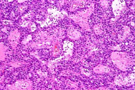 Urothelial carcinoma with glandular differentiation, high mag