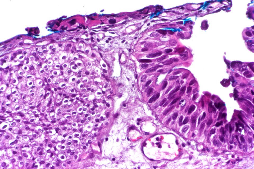 Urothelial carcinoma in situ (denuding), very high mag