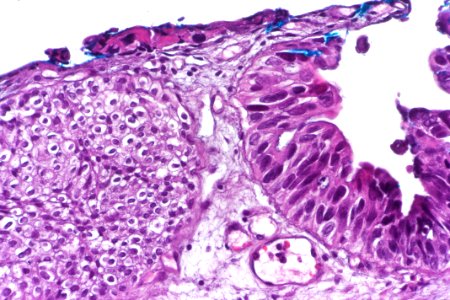 Urothelial carcinoma in situ (denuding), very high mag