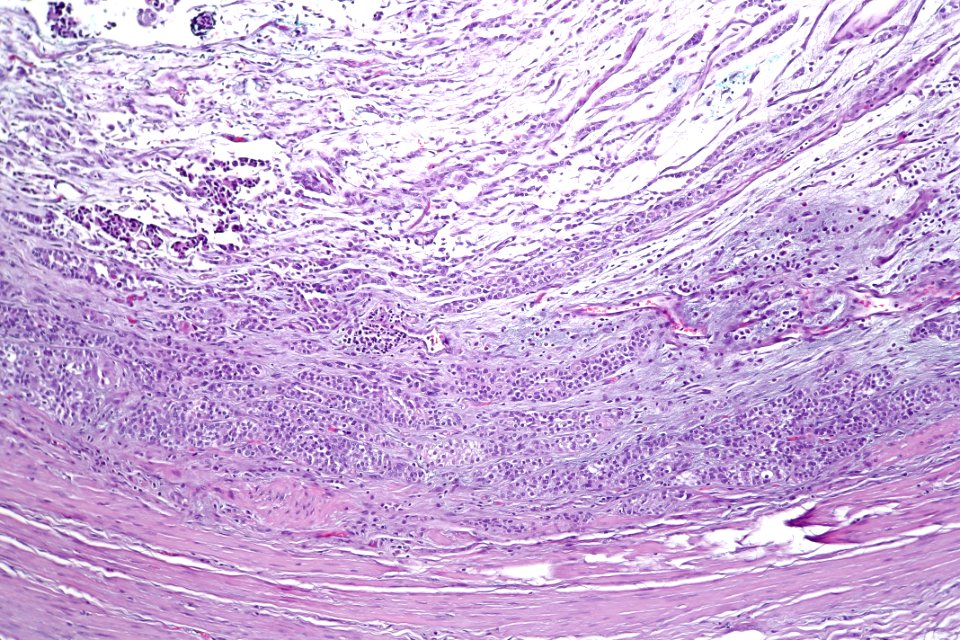 Urothelial carcinoma of the ureter, intermed. mag.2