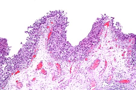 Urothelial carcinoma in situ, intermed. mag