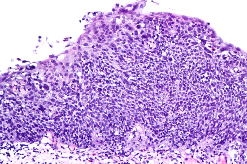 Urothelial carcinoma in situ (hyperplastic), high mag