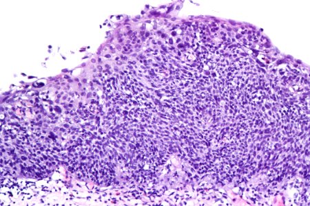 Urothelial carcinoma in situ (hyperplastic), high mag