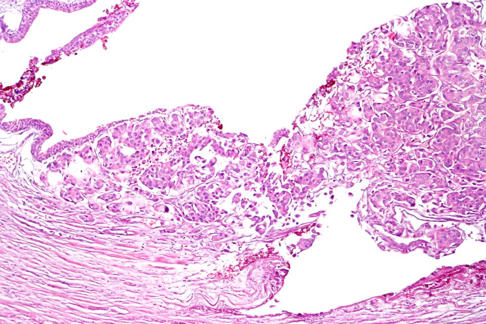Urothelial carcinoma in the prostatic urethra, intermed. mag