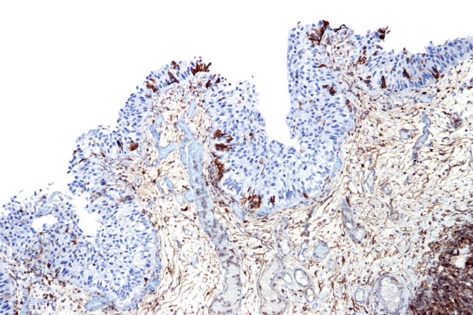 Urothelial carcinoma in situ - CD44, intermed. mag