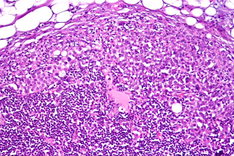 Urothelial carcinoma - lymph node metastasis, high mag