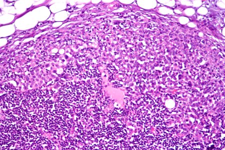 Urothelial carcinoma - lymph node metastasis, high mag photo