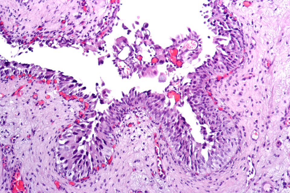 Urothelial carcinoma in situ (micropapillary), intermed mag.2