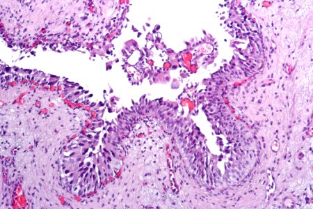 Urothelial carcinoma in situ (micropapillary), intermed mag.2