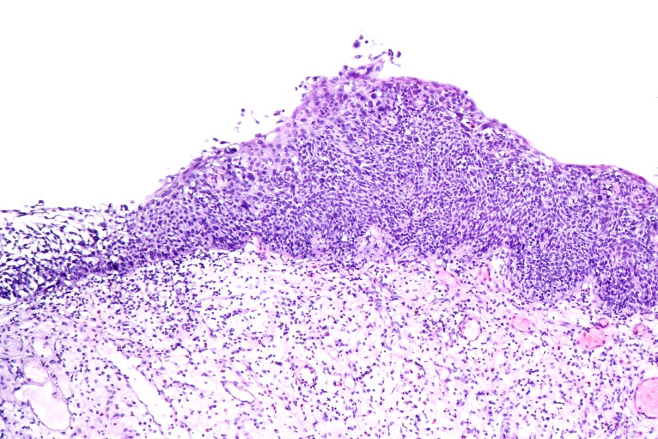 Urothelial carcinoma in situ (hyperplastic), intermed. mag