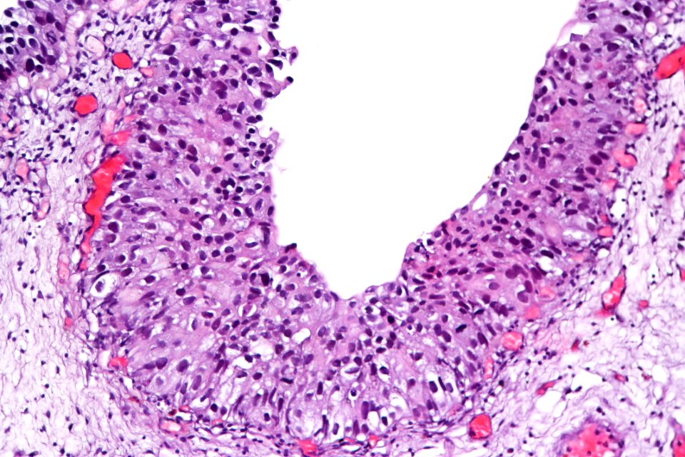 Urothelial carcinoma in situ, high mag