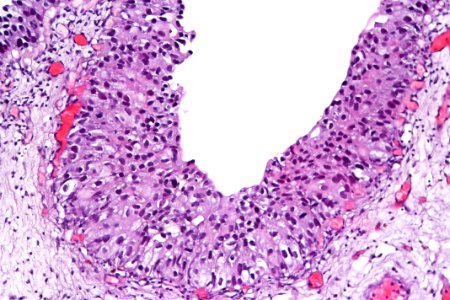 Urothelial carcinoma in situ, high mag