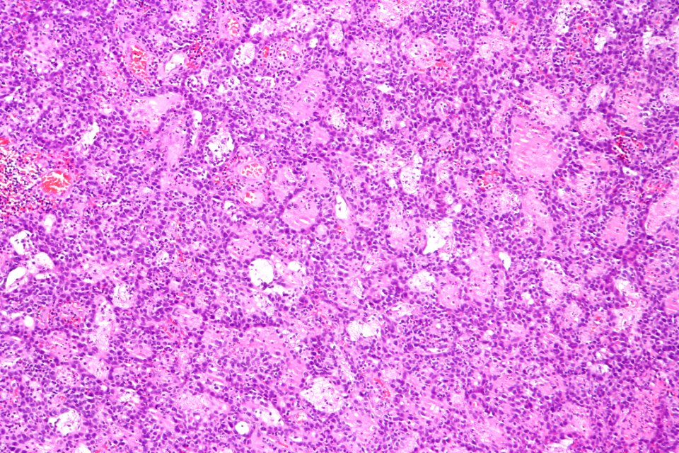 Urothelial carcinoma with glandular differentiation, intermed. mag