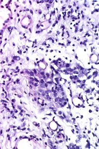 Urothelial carcinoma in situ with invasion, very high mag