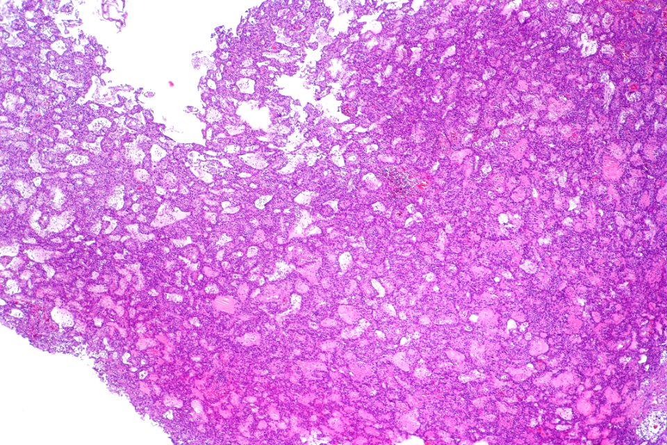 Urothelial carcinoma with glandular differentiation, low mag