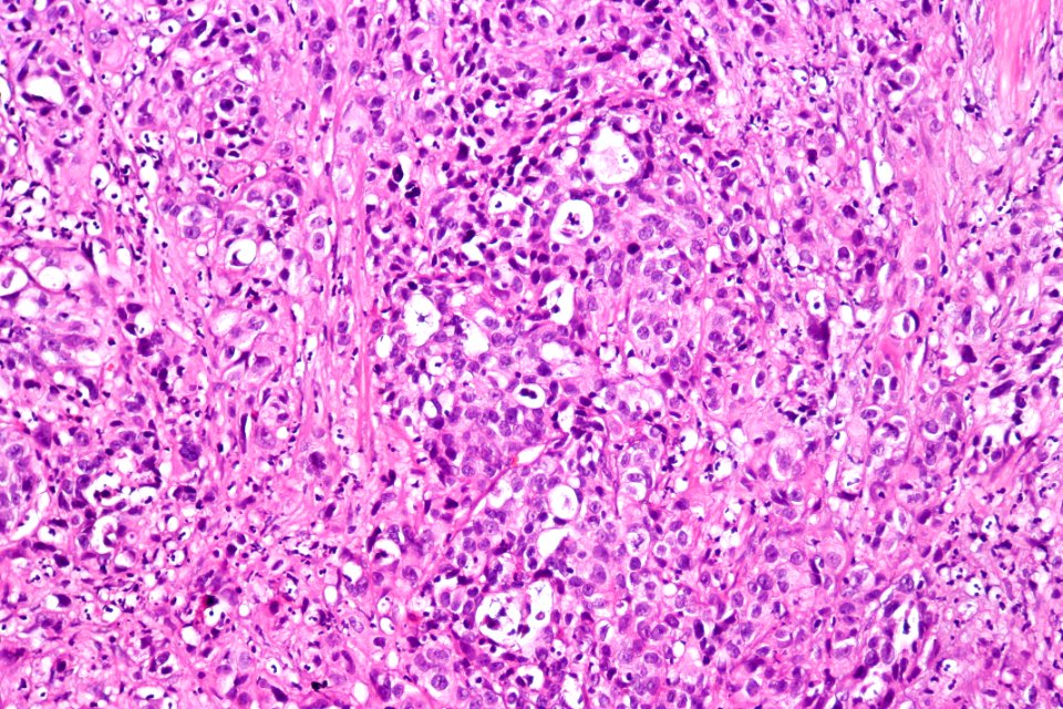 Urothelial carcinoma with glandular differentiation, high mag.1