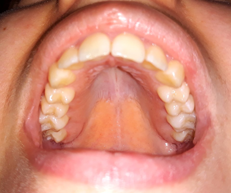 UpperPermanentTeeth