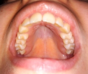 UpperPermanentTeeth