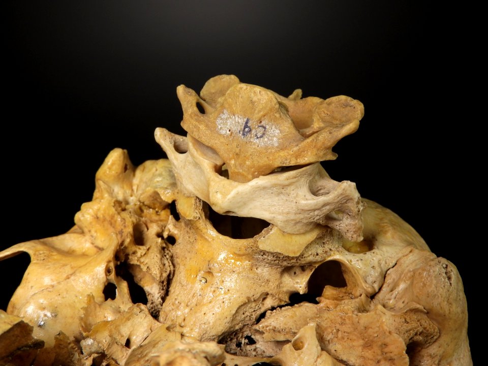 Vertebra - atlas, axis (skull junction)