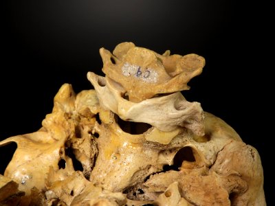 Vertebra - atlas, axis (skull junction)