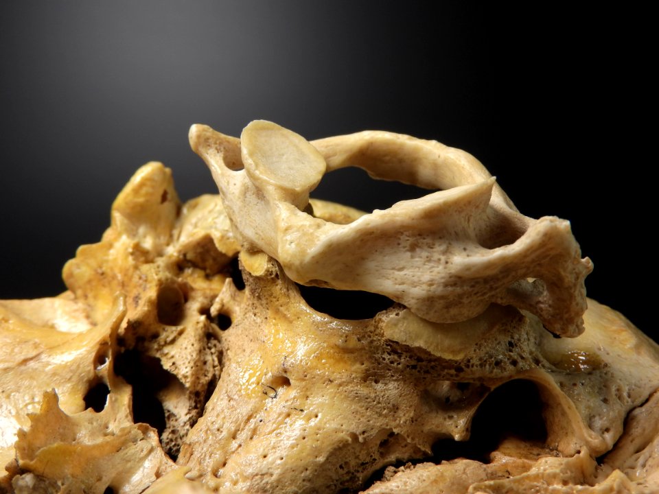 Vertebra - atlas junction