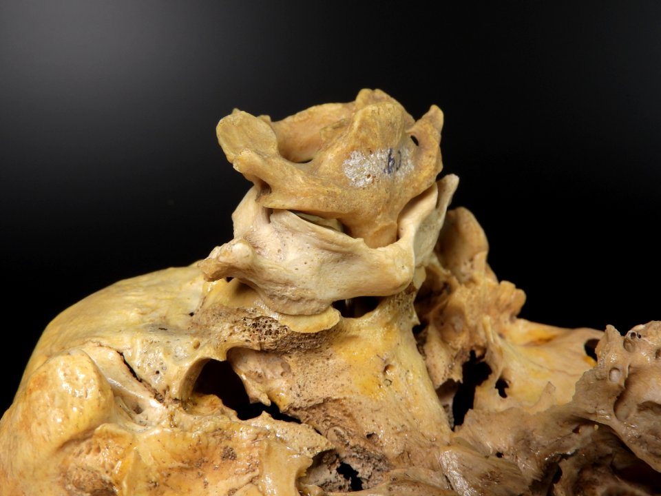 Vertebra - atlas, axis (skull junction) 2