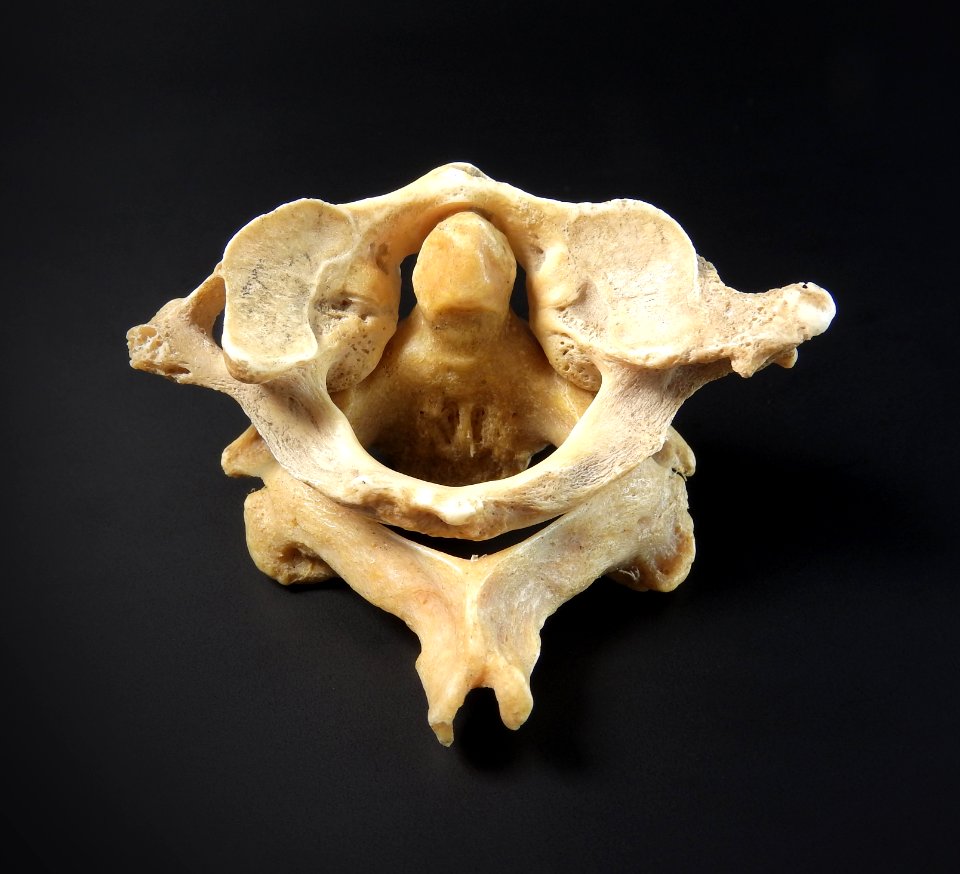 Vertebra - atlas, axis (superior)