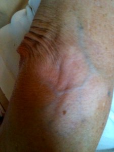 Vitiligo depigmentation