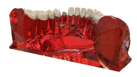3d model orthodontics the implant