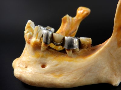 Cranium - mandibula (dental bridge and foramen mentale detail, dentistry)