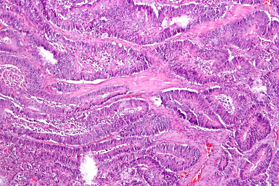 Adenocarcinoma (intestinal type) of the urinary bladder, intermed. mag.2