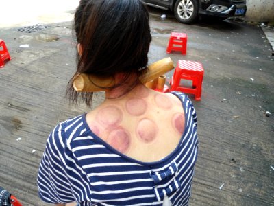 Fire cupping in Haikou - 04