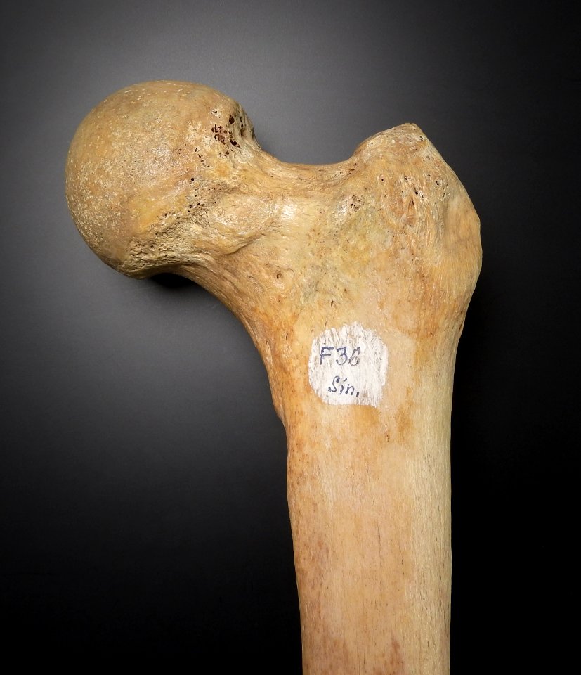 Femur - caput femoris (anterior)