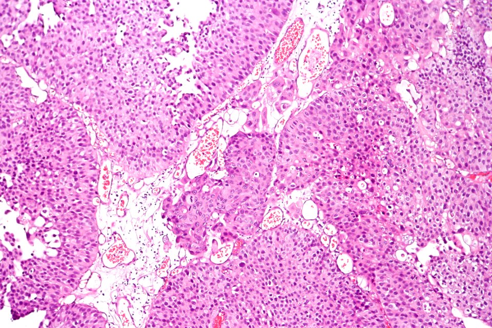Papillary urothelial carcinoma with early invasion, intermed. mag
