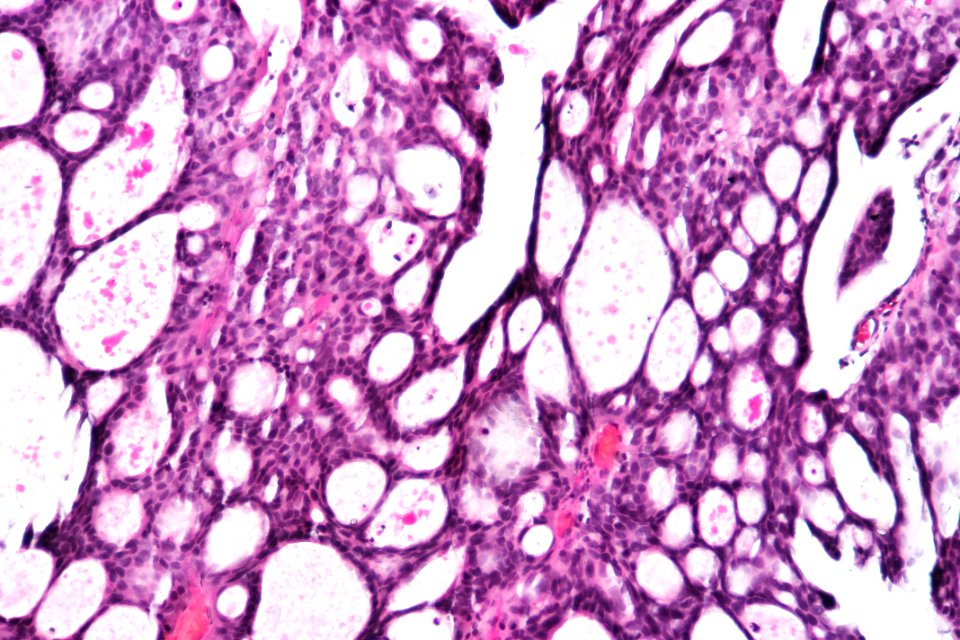 Papillary urothelial carcinoma with cribriform morphology, high mag