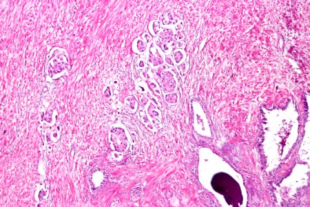 Urothelial carcinoma with invasion into the seminal vesicle, intermed. mag