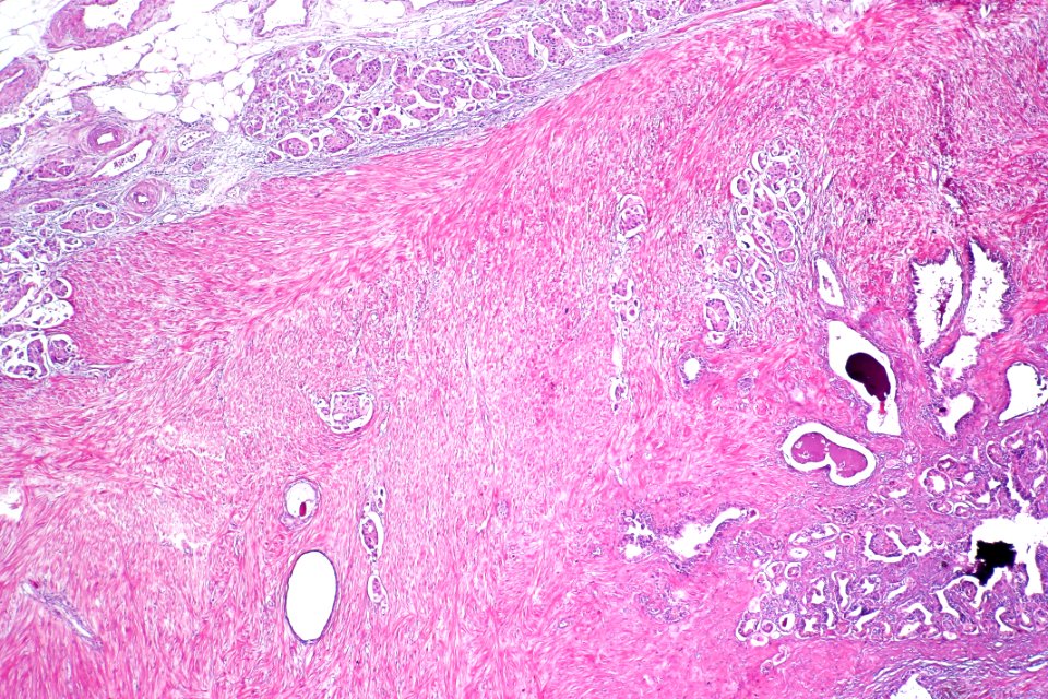 Urothelial carcinoma with invasion into the seminal vesicle, low mag