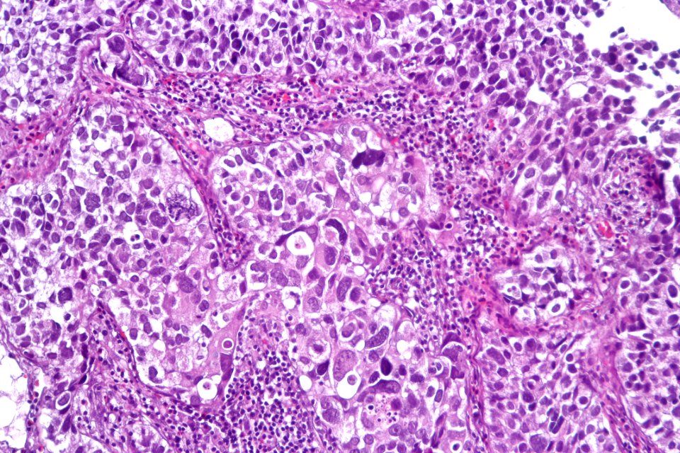 Urothelial carcinoma with marked pleomorphism, high mag.2