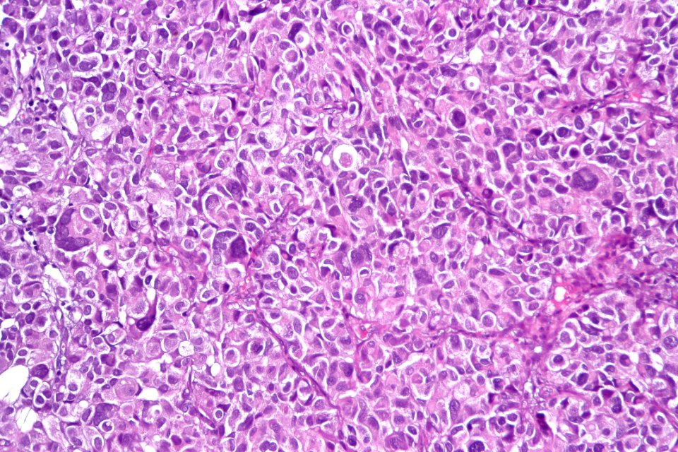 Urothelial carcinoma with marked pleomorphism, high mag.1