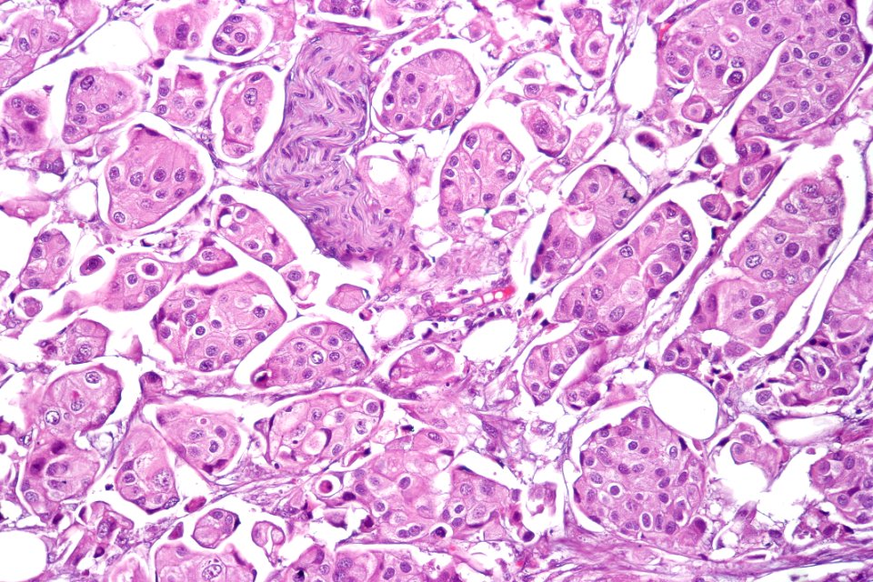 Urothelial carcinoma with micropapillary features, high mag