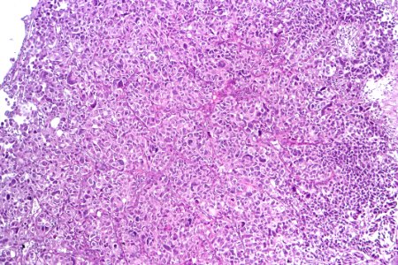 Urothelial carcinoma with marked pleomorphism, intermed. mag.2