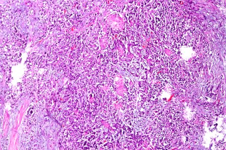 Urothelial carcinoma with squamous differentiation, intermed. mag