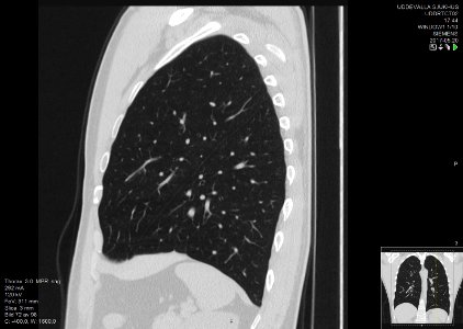 High-resolution computed tomograph of a normal thorax, sagittal plane (72)