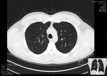High-resolution computed tomograph of a normal thorax, axial plane (29)