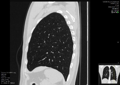 High-resolution computed tomograph of a normal thorax, sagittal plane (77)