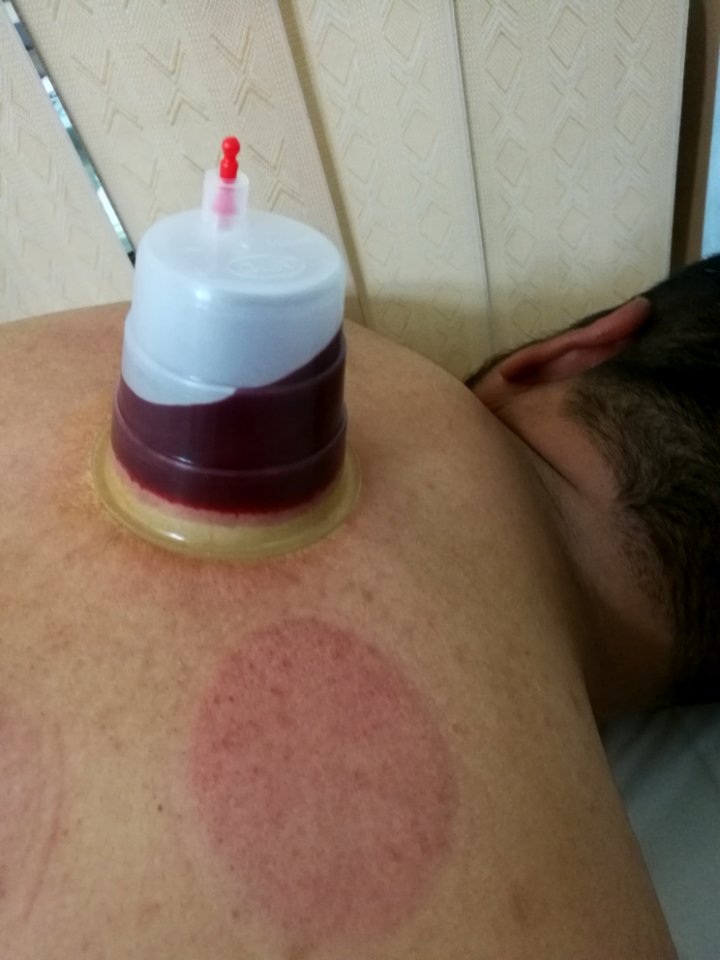 Hijama in Iran 04
